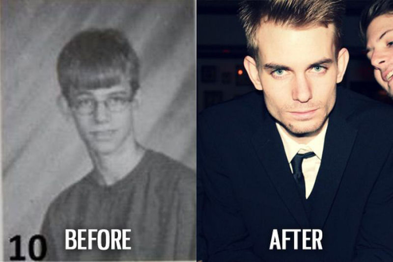 Antes e depois de pessoas com síndrome do patinho feio 55