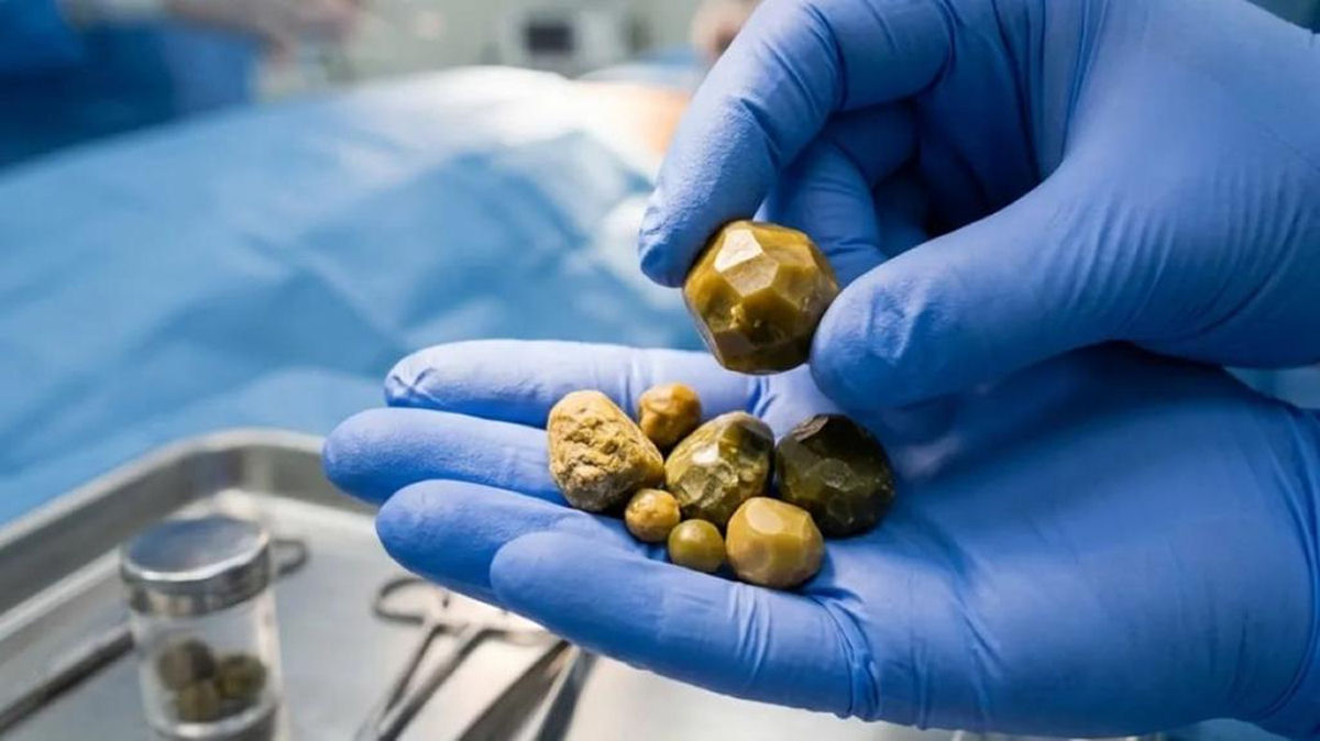 C�lculos biliares bovinos, que valem o dobro do ouro, impulsionam um frenesi global de contrabando