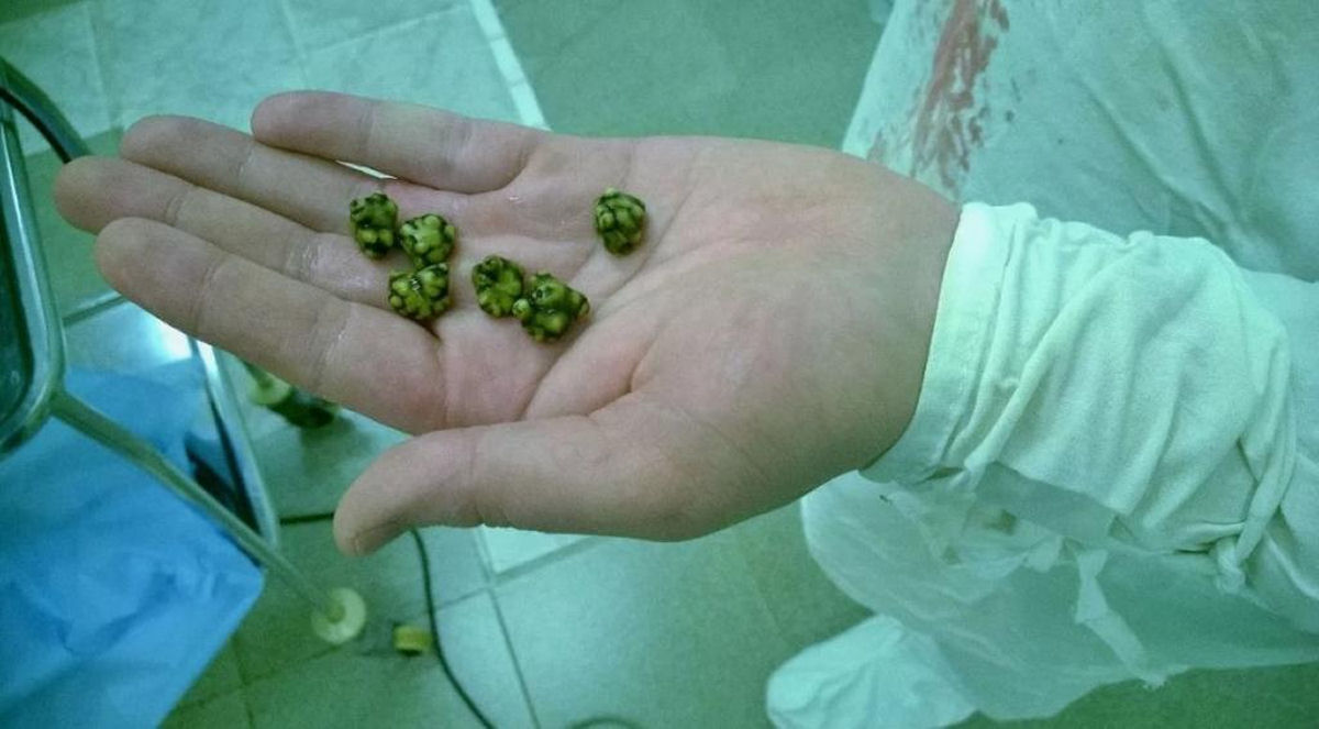 C�lculos biliares bovinos, que valem o dobro do ouro, impulsionam um frenesi global de contrabando