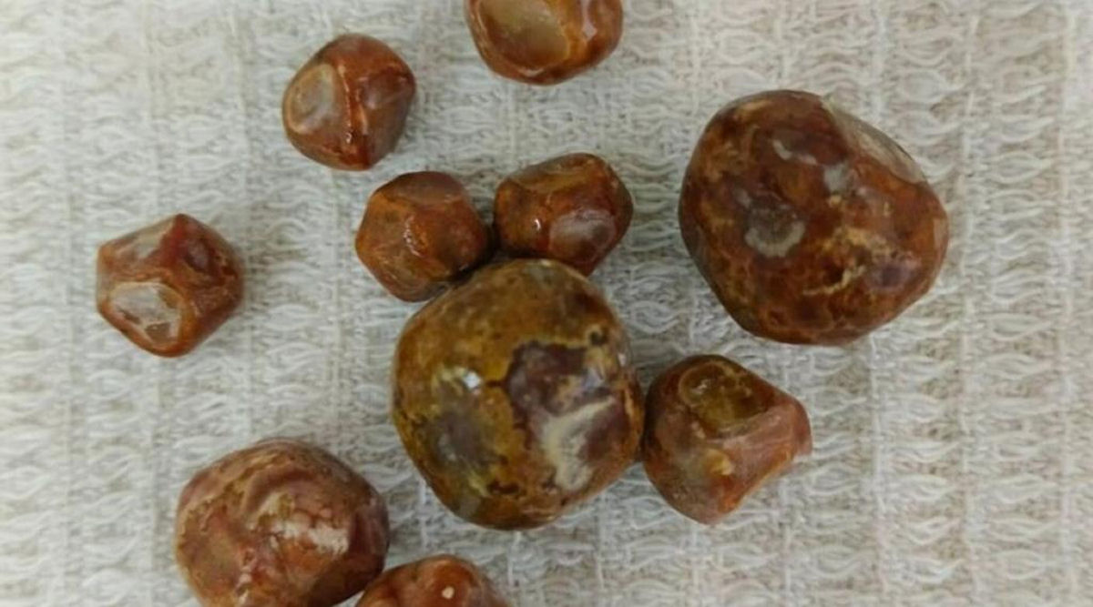 C�lculos biliares bovinos, que valem o dobro do ouro, impulsionam um frenesi global de contrabando