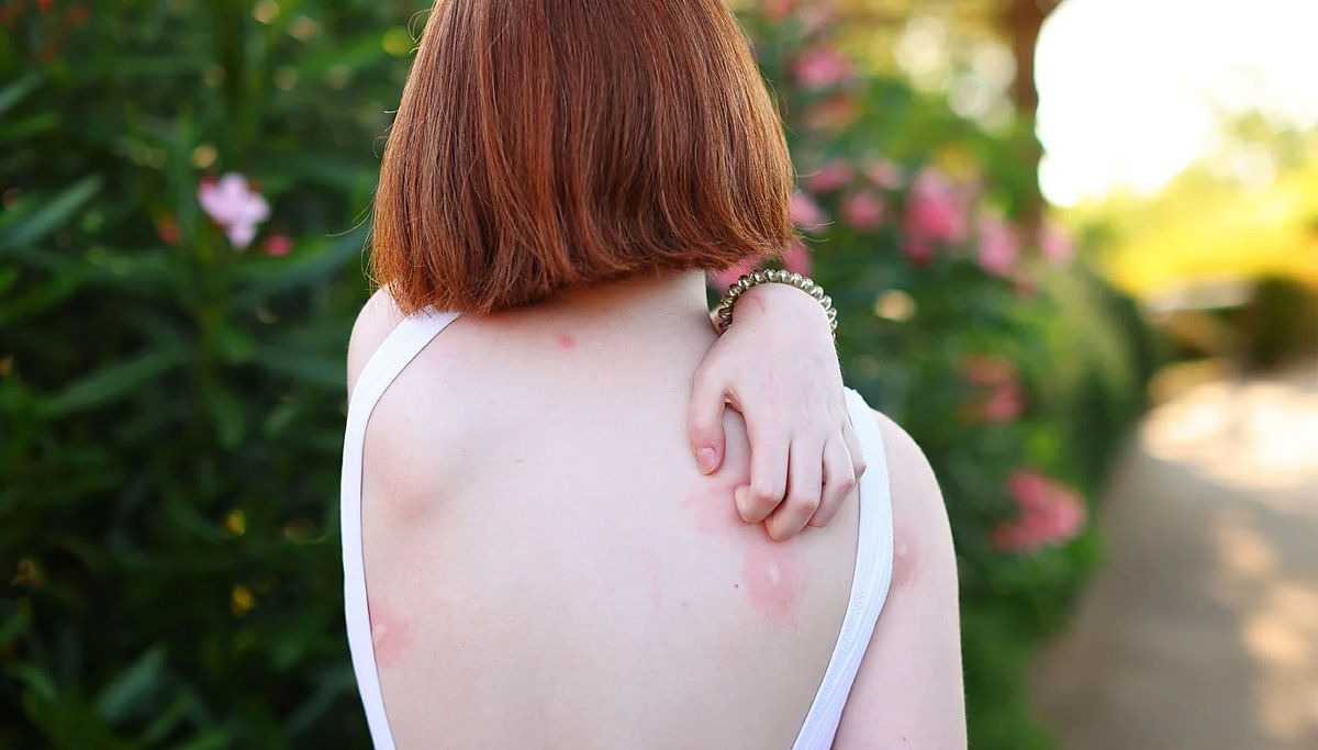 Por que os mosquitos picam algumas pessoas mais do que outras?