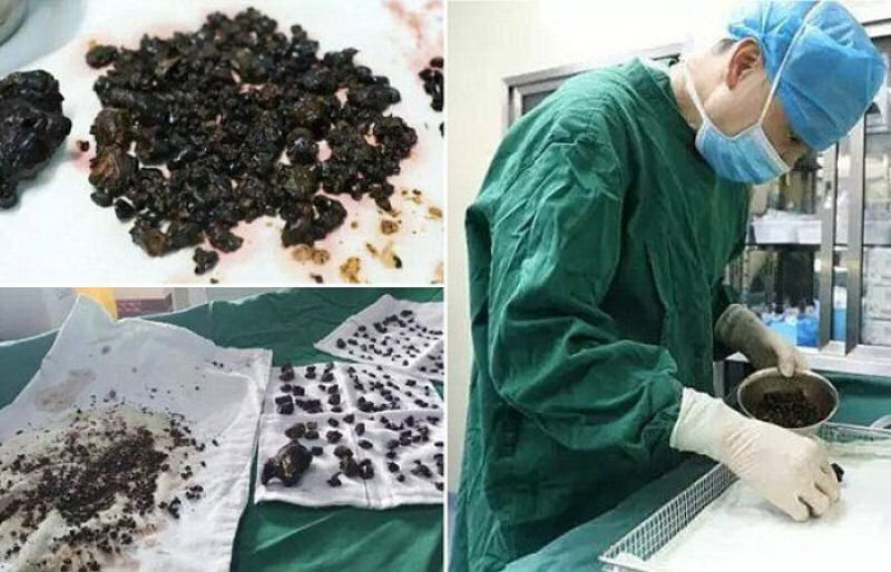 Mdicos removem mais de 200 pedras do corpo de uma mulher em uma nica operao