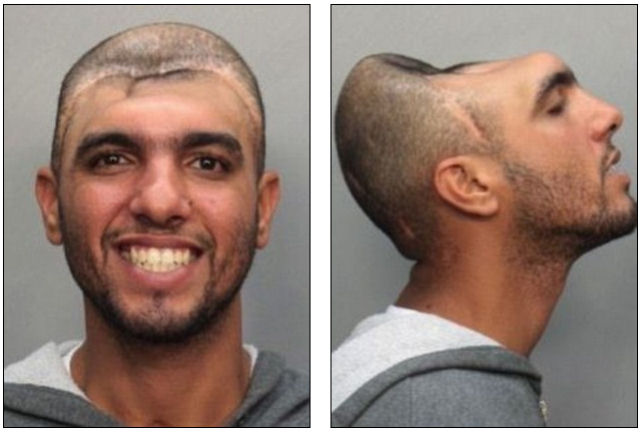 Homem forçado a viver com metade da cabeça após quebrar o crânio em queda 07