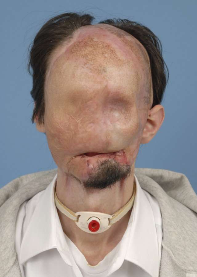 O primeiro homem a fazer transplante de face total nos EUA
