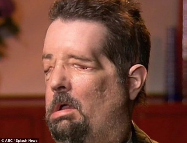 O primeiro homem a fazer transplante de face total nos EUA