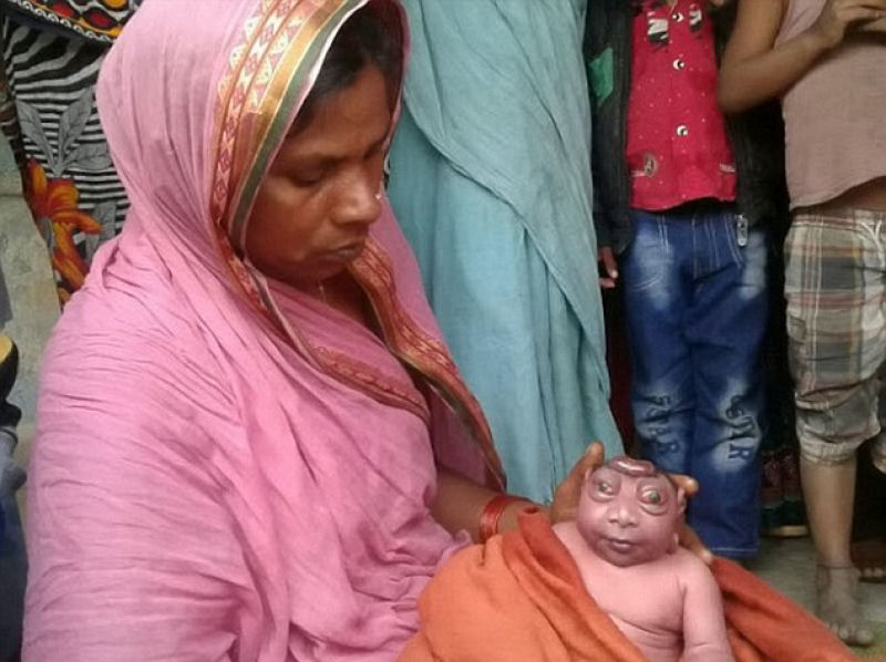 Mãe se nega a amamentar bebê que nasceu com cabeça minúscula e olhos esbugalhados