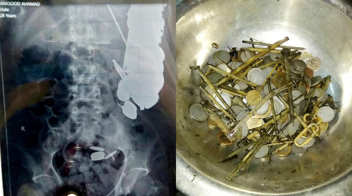 Cofrinho humano: mdicos removem 263 moedas do estmago de um indiano