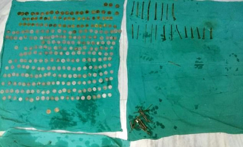 Cofrinho humano: mdicos removem 263 moedas do estmago de um indiano