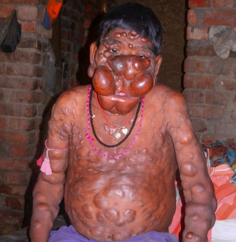 Menino indiano no tem convvio social devido a tumores que no param de crescer em seu rosto e corpo