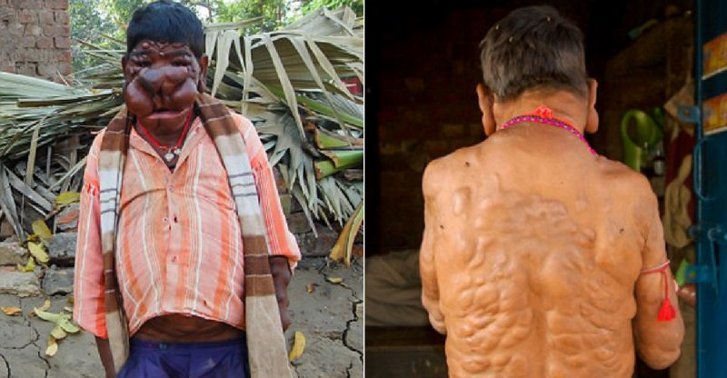 Menino indiano no tem convvio social devido a tumores que no param de crescer em seu rosto e corpo