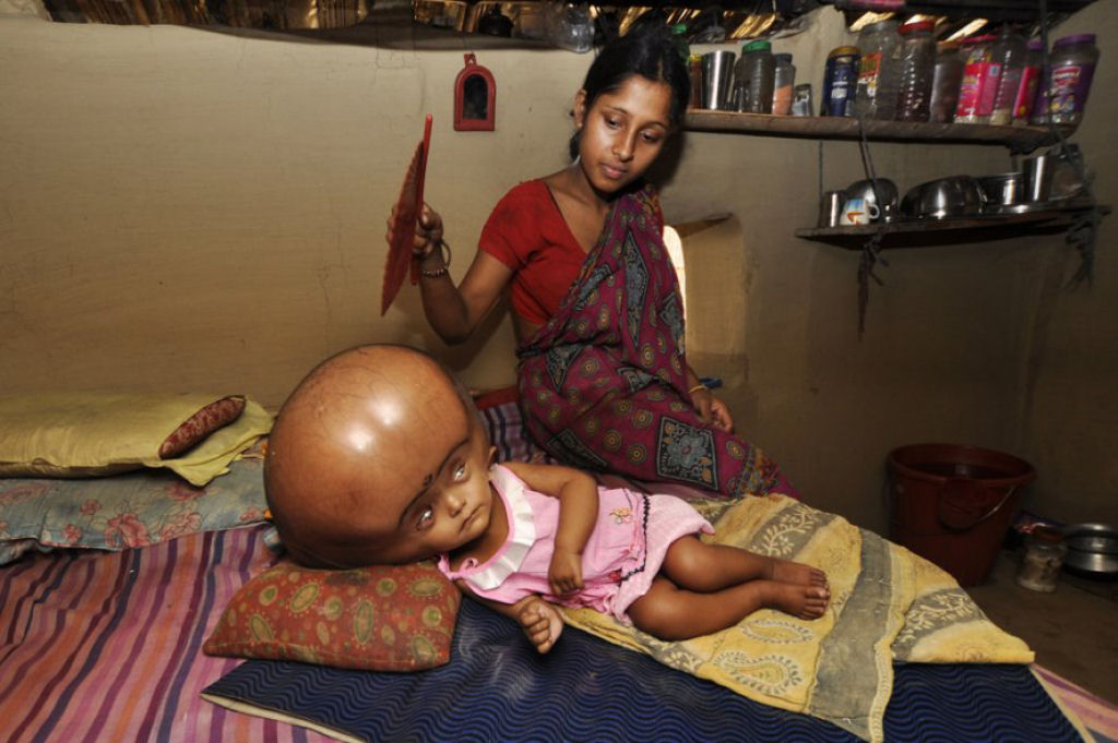 Internautas criam campanha para tratar garota indiana com hidroencefalia 04