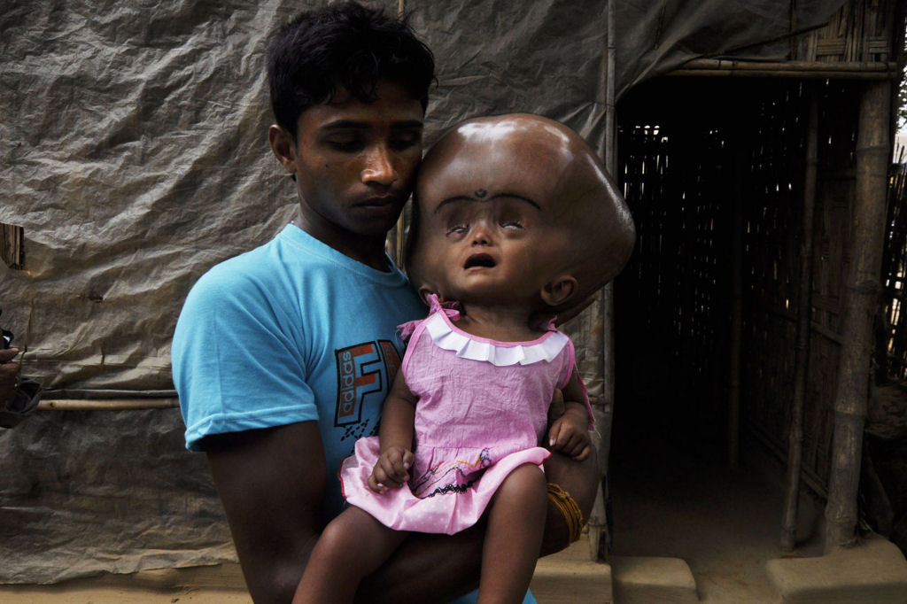 Internautas criam campanha para tratar garota indiana com hidroencefalia 05