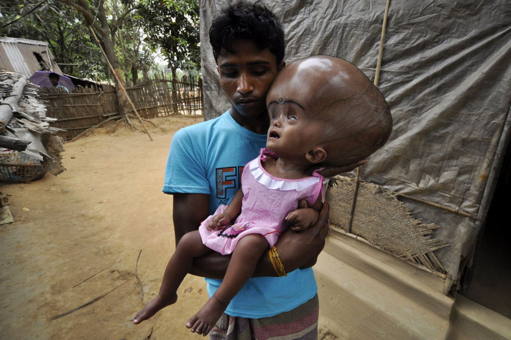 Internautas criam campanha para tratar garota indiana com hidroencefalia 06