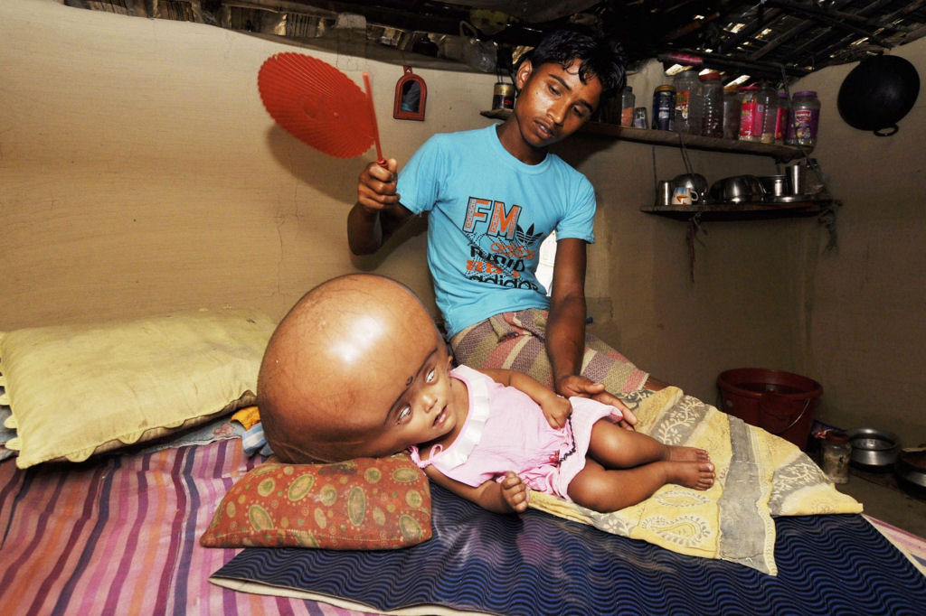 Internautas criam campanha para tratar garota indiana com hidroencefalia 07