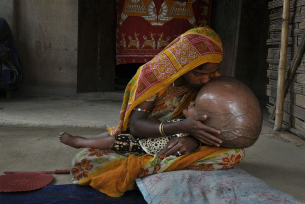 Internautas criam campanha para tratar garota indiana com hidroencefalia 10