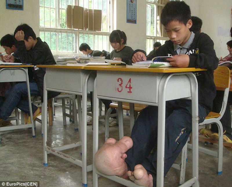 Adolescente chinês sofre de uma terrível doença nos pés