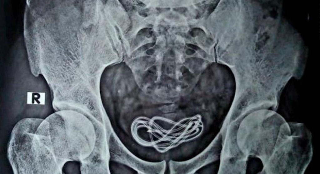 Encontram um cabo de carregador de celular na uretra de um paciente indiano