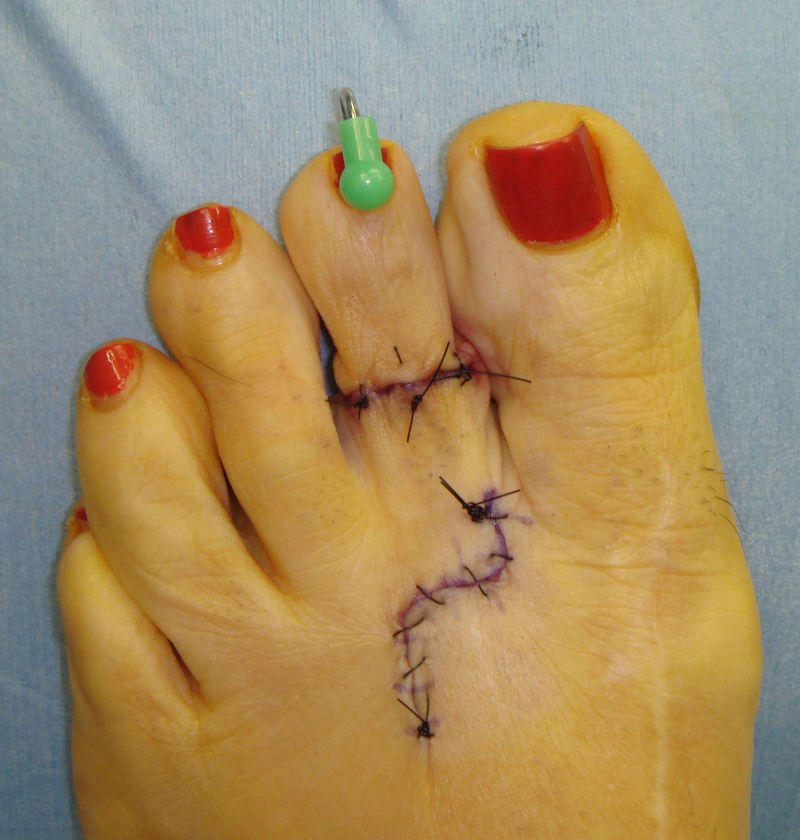 Cirurgia Cinderella: um procedimento bizarro de encurtamento dos dedos dos ps