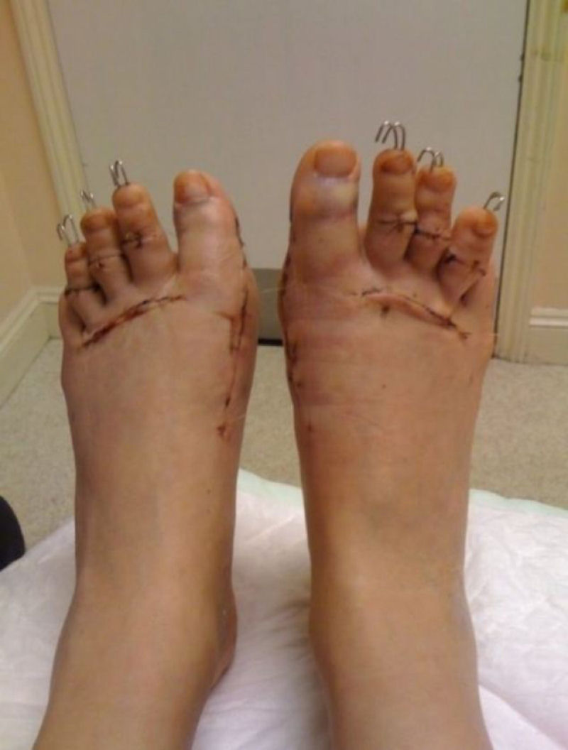 Cirurgia Cinderella: um procedimento bizarro de encurtamento dos dedos dos ps