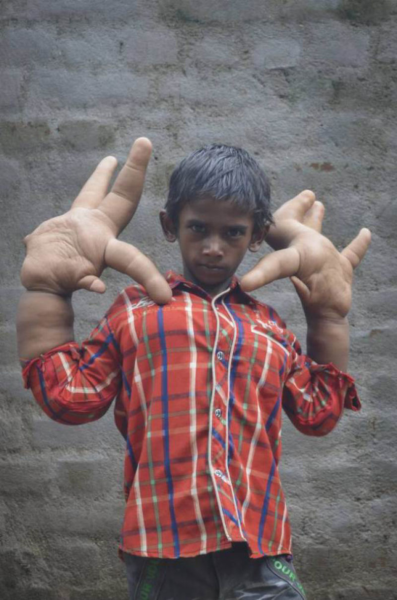 O estranho caso do garoto indiano com mãos gigantes que deixou médicos desconcertados 01