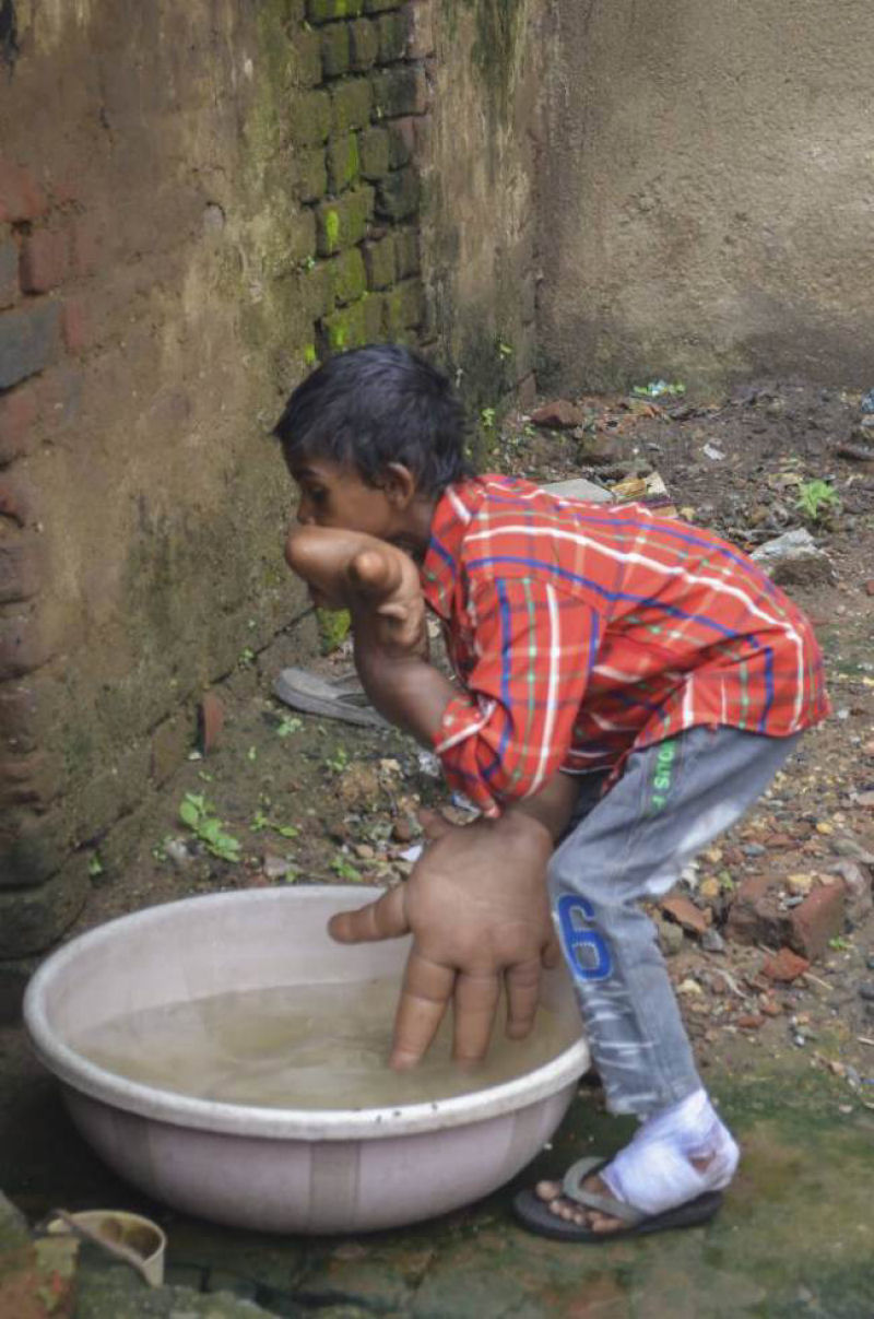 O estranho caso do garoto indiano com mãos gigantes que deixou médicos desconcertados 04