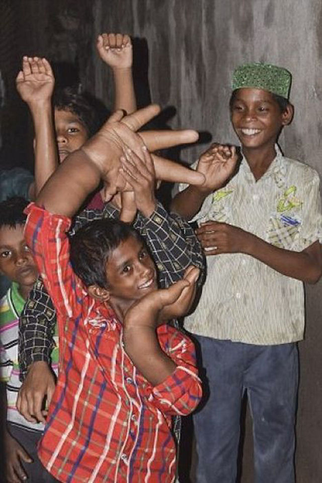 O estranho caso do garoto indiano com mãos gigantes que deixou médicos desconcertados 07