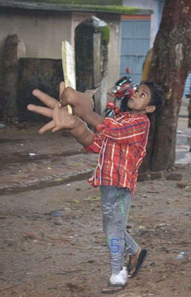 O estranho caso do garoto indiano com mãos gigantes que deixou médicos desconcertados 10