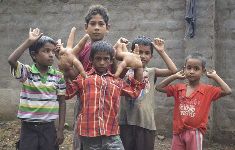 O estranho caso do garoto indiano com mãos gigantes que deixou médicos desconcertados 11