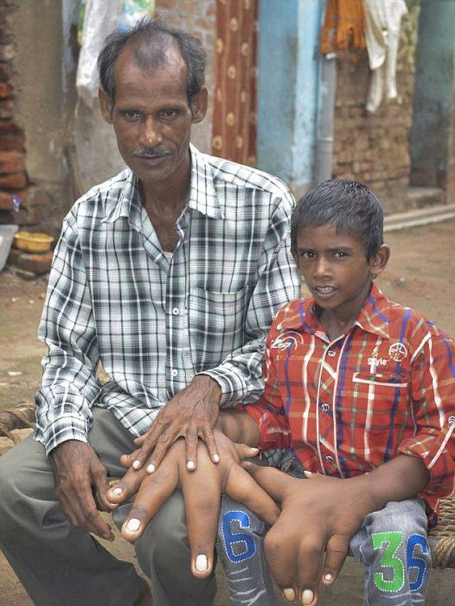 O estranho caso do garoto indiano com mãos gigantes que deixou médicos desconcertados 12