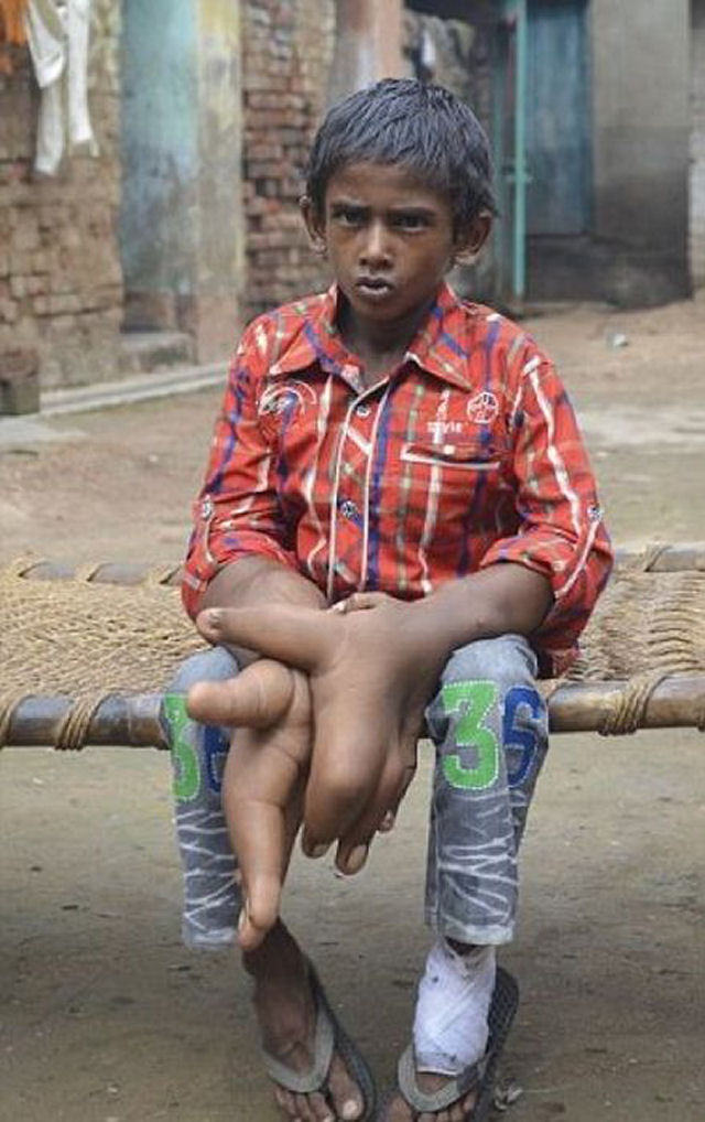 O estranho caso do garoto indiano com mãos gigantes que deixou médicos desconcertados 13