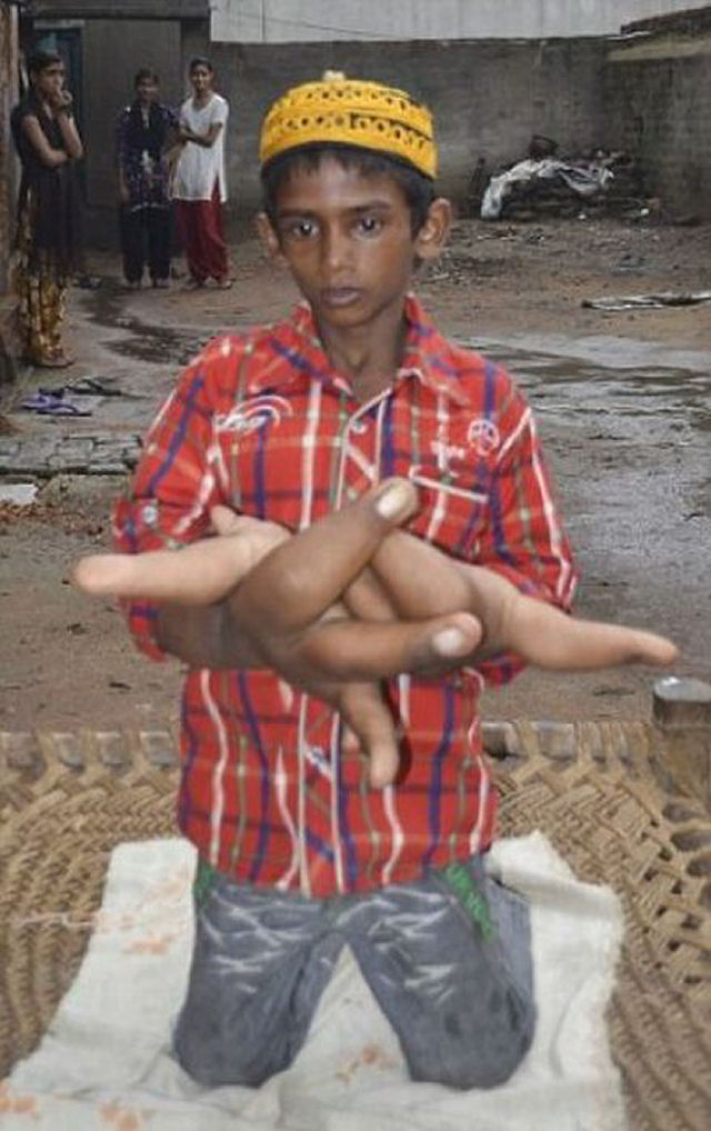 O estranho caso do garoto indiano com mãos gigantes que deixou médicos desconcertados 14