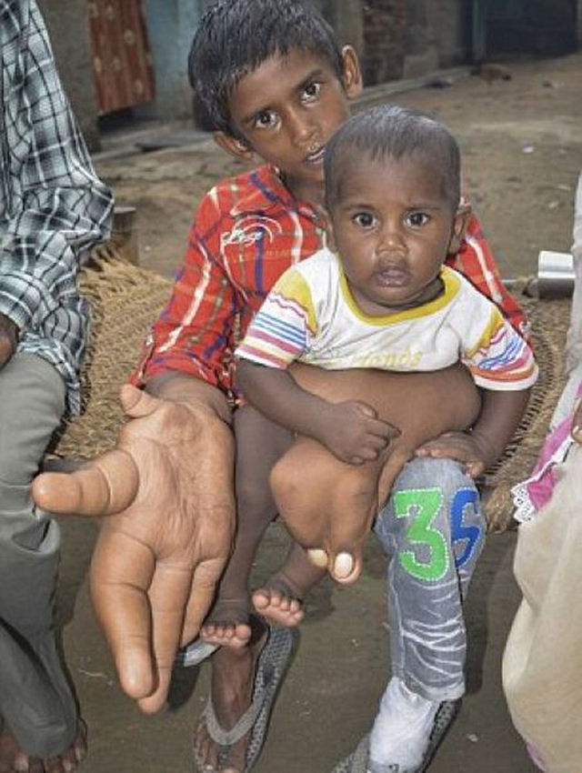 O estranho caso do garoto indiano com mãos gigantes que deixou médicos desconcertados 15