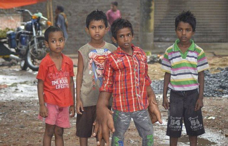 O estranho caso do garoto indiano com mãos gigantes que deixou médicos desconcertados 18