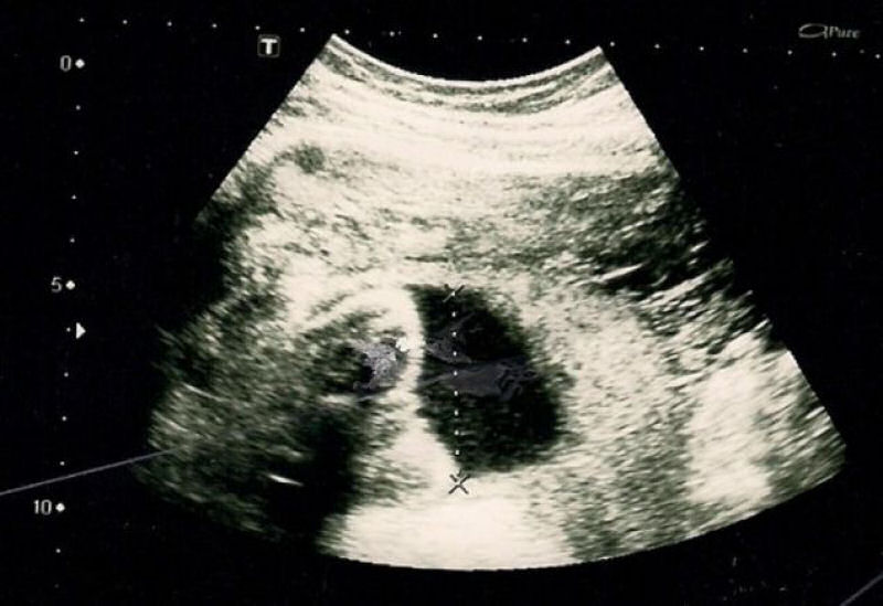 O insólito caso da garota sem vagina que ficou grávida depois de ser apunhalada