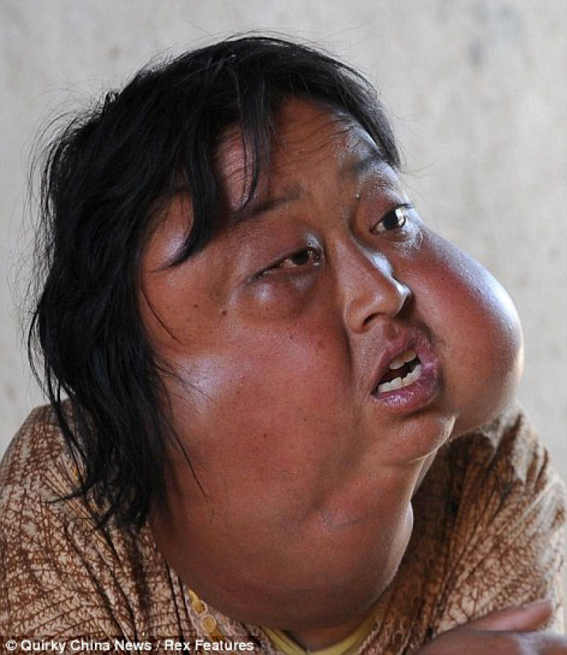 Incrível transformação da mãe chinesa desfigurada pelo cordoma, depois da cirurgia 01