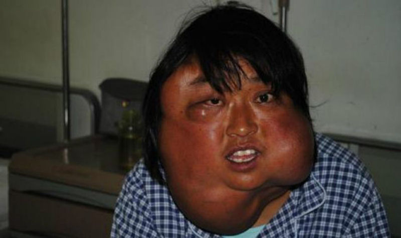 Incrível transformação da mãe chinesa desfigurada pelo cordoma, depois da cirurgia 02