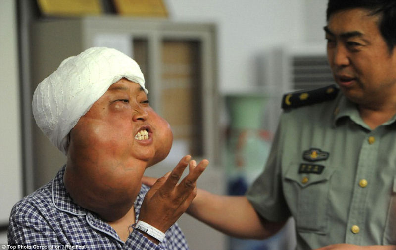 Incrível transformação da mãe chinesa desfigurada pelo cordoma, depois da cirurgia 03