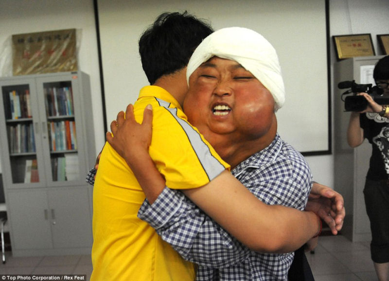 Incrível transformação da mãe chinesa desfigurada pelo cordoma, depois da cirurgia 04