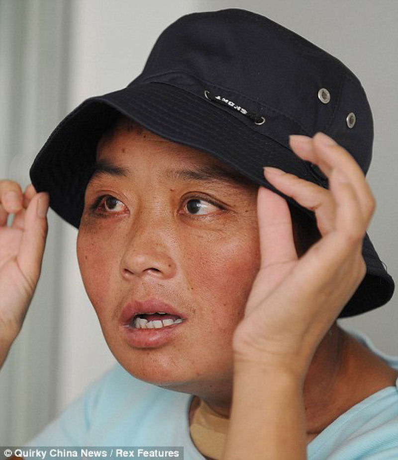 Incrível transformação da mãe chinesa desfigurada pelo cordoma, depois da cirurgia 06