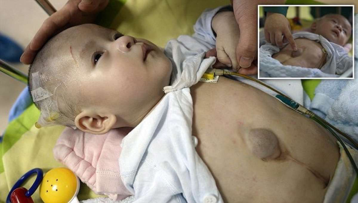 Este bebê nasceu com o coração fora do peito e por isso foi abandonado pelos pais