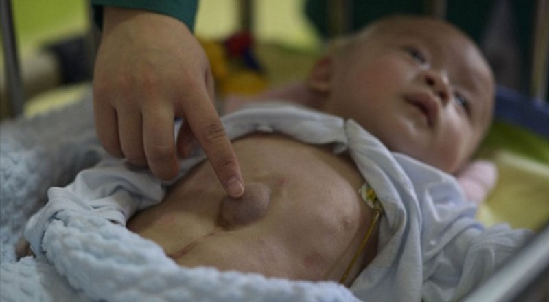Este bebê nasceu com o coração fora do peito e por isso foi abandonado pelos pais