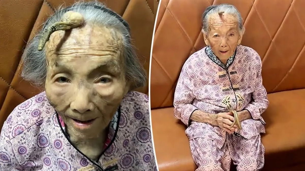 Chinesa de 107 anos tem um grande chifre crescendo na testa