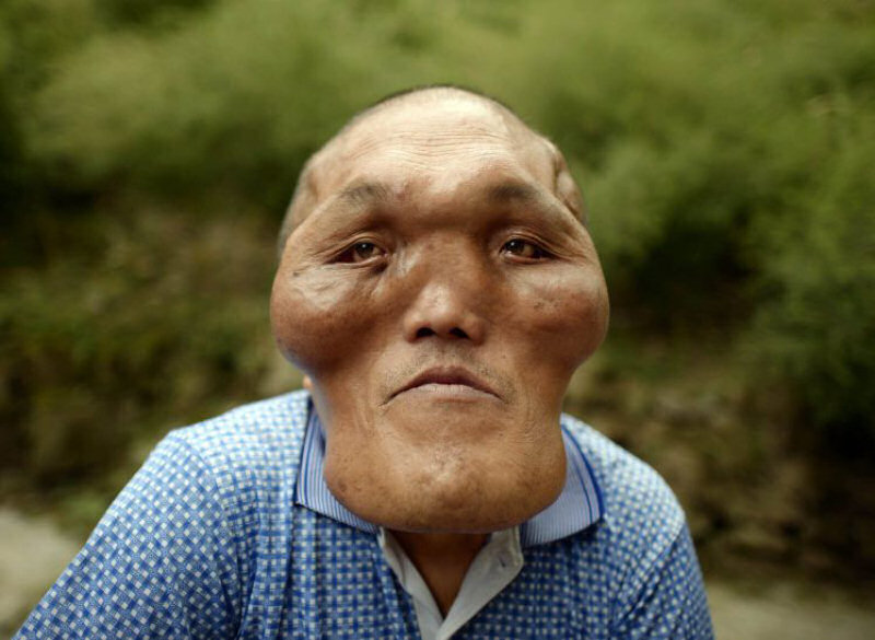 Chinês com severas deformidades faciais nessescita de cirurgia 02