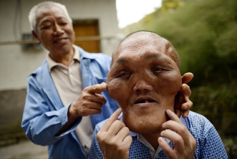Chinês com severas deformidades faciais nessescita de cirurgia 04