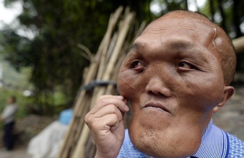 Chinês com severas deformidades faciais nessescita de cirurgia 05
