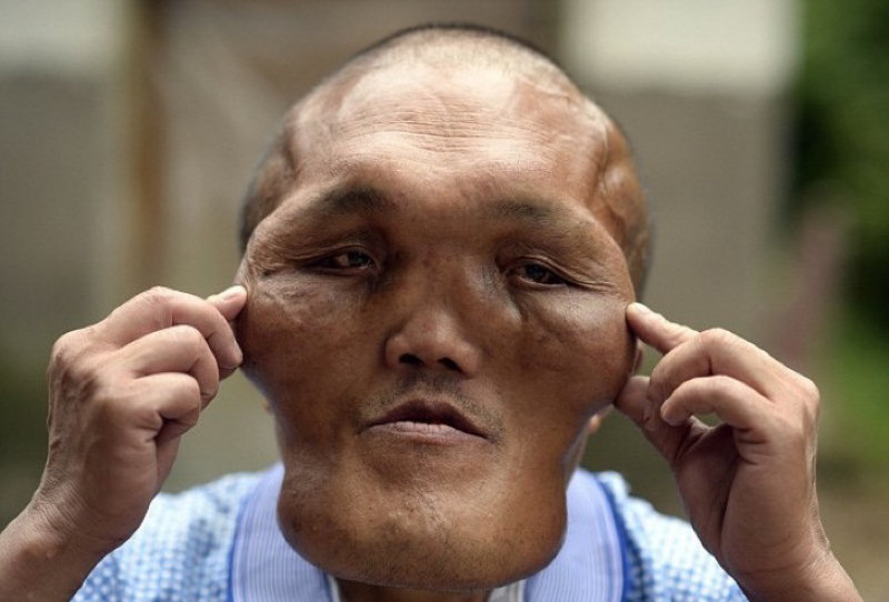 Chinês com severas deformidades faciais nessescita de cirurgia 06