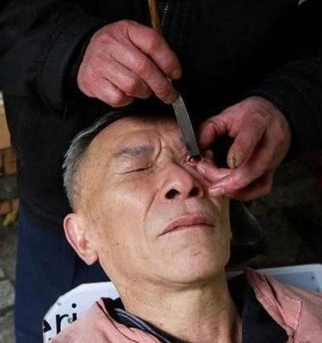 A perigosa raspagem de olho praticada por barbeiros chineses