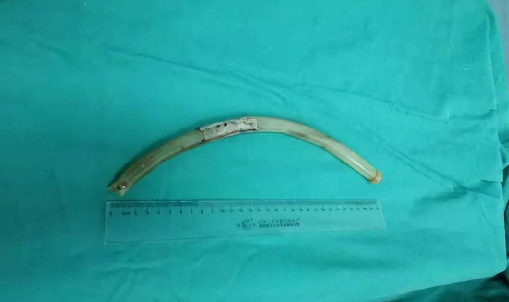 Jovem chinesa engole acidentalmente um 'tubo de vmito' de 30 cm de comprimento usado para perder peso