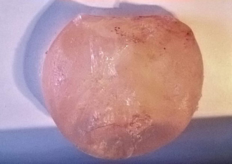 Britnica retira seus prprios implantes mamrios usando um estilete