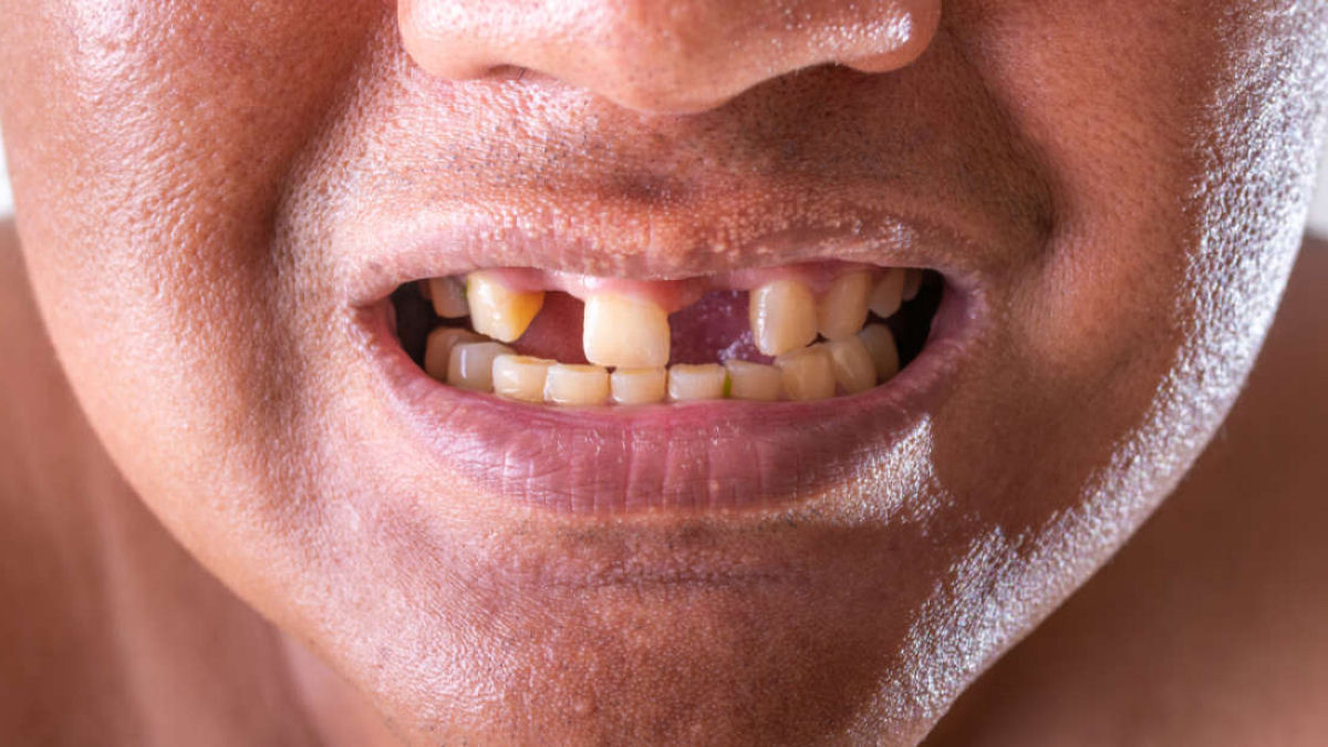 Cientistas japoneses criam uma droga experimental que promete fazer crescer dentes